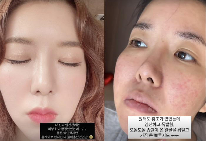 '쌍둥이 임신' 김지혜, 낙상사고 후 또 안타까운 근황 "홍조·좁쌀·뾰루…