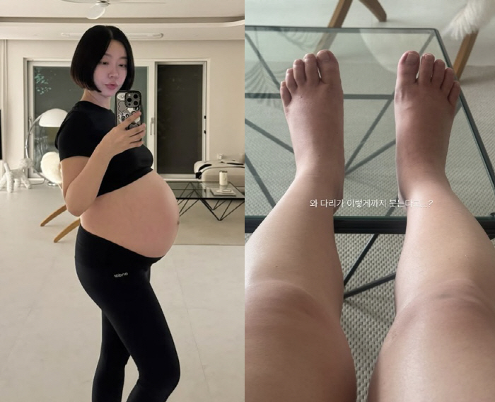 '쌍둥이 임신' 레이디 제인, 출산 앞두고 다리 부기 심각 "이 정도라니…