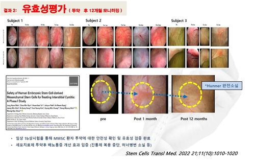 난치병 '간질성방광염' 줄기세포 치료 임상시험 세계 첫 성공