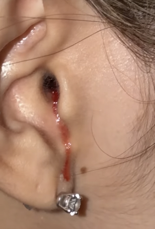 블랙핑크 리사, 日 여행 중 '귀에서 피 철철'…완전체 컴백 어쩌나[SC…