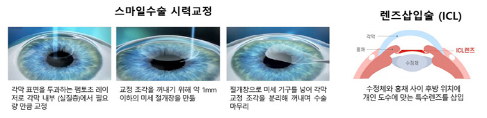 방학 시즌 시력 교정, 스마일라식·렌즈삽입술 효과 비교했더니…
