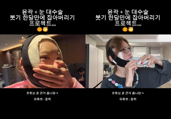 '故최진실 딸' 최준희, '광대 성형' 후 달라진 얼굴 "뼈는 안 건드려…