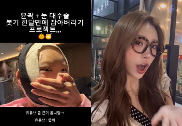 '故 최진실 딸' 최준희, 성형수술 후 커다랗게 부은 얼굴...