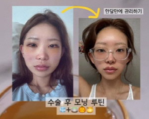 '故 최진실 딸' 최준희, '광대 수술' 과정 공개…확 달라진 얼굴[SCin스타]