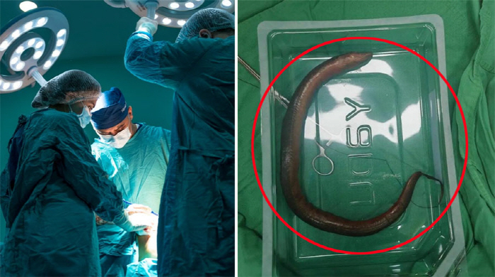 뱃속에서 살아 있는 30cm 장어 '꿈틀'…어쩌다 들어갔을까?
