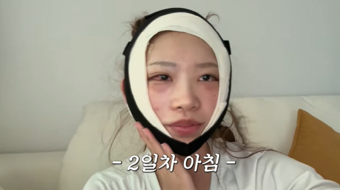 '故 최진실 딸' 최준희, 광대·눈 성형 후 심각한 부기 "앞이 안 보여…