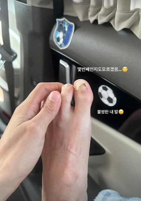 이현이, 발톱 빠지기 직전 충격적인 상태…"불쌍한 내발"