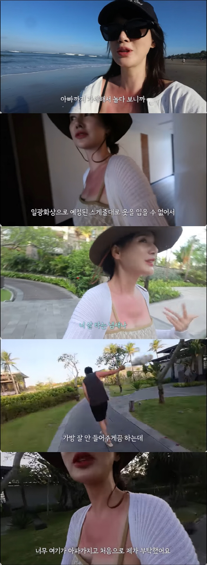 '안정환♥' 이혜원, 발리 여행 중 화상 입었다 "너무 아파 옷도 못 입…