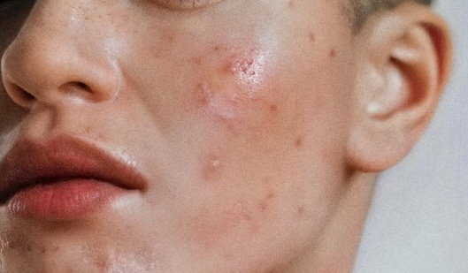 안 낫는 여드름, 비약물 치료법 총정리…효과 비교해 보니