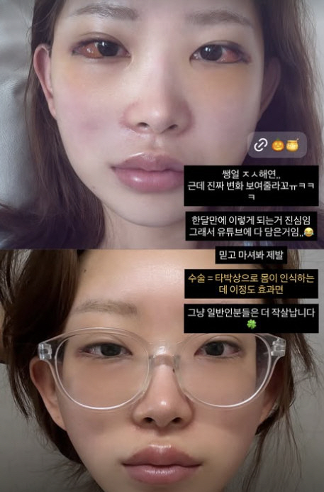 '故 최진실 딸' 최준희, 광대·눈 성형에 흰자까지 부었는데…한 달만 놀라운 변화