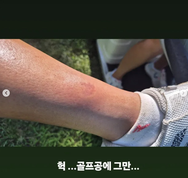 '박준형♥' 김지혜, 골프치다 아찔 부상…붕대 칭칭 감고 "공이 다리로 …