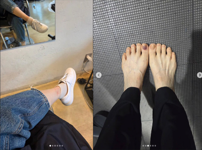'김태욱♥' 채시라, 새까맣게 멍든 발톱 공개… "제발 빠지지만 말아줘"