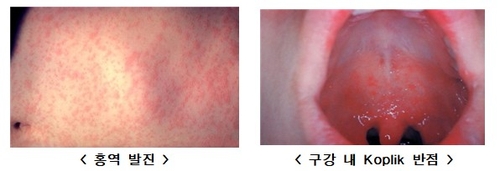 국내 홍역환자, 작년의 1.4배…"베트남 등 해외여행시 주의"