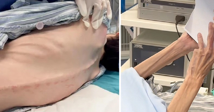 12년간 다이어트약 하루 200알 먹은 여성, 체중 불과 25kg '충격…
