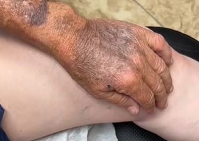 "이래도 자외선 차단제 안 바를래?"…70년간 팔만 노출한 남성, 충격 …