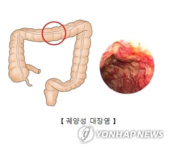염증성 장질환 환자 10명 중 3명 비만…10여년새 비율 2.3배↑
