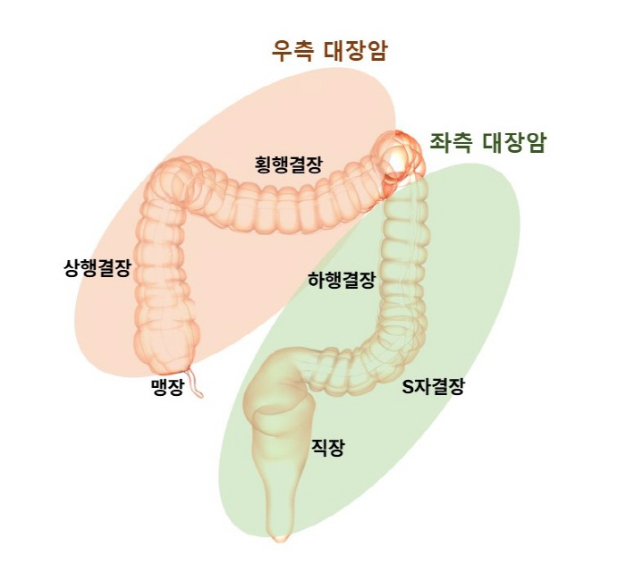 여성 대장암 절반 이상이 '오른쪽'…암 발생 경로부터 달라