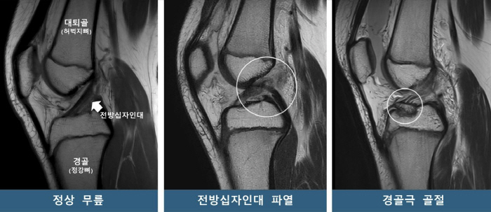 "소아청소년 무릎, 타고난 모양 따라 부상 양상 달라"
