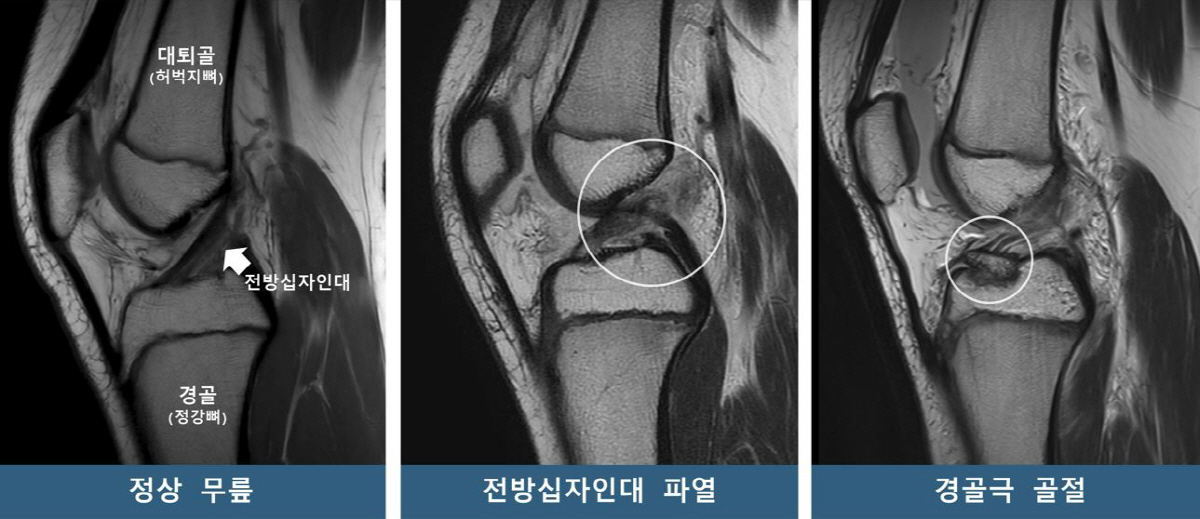 "소아청소년 무릎, 타고난 모양 따라 부상 양상 달라"