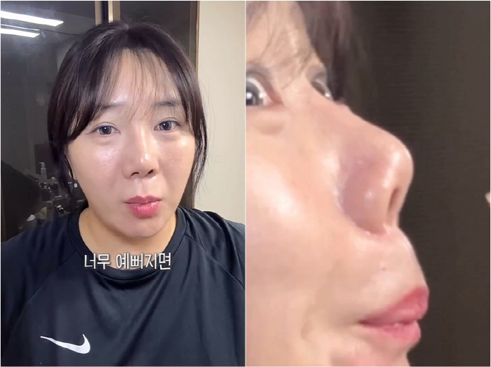 허안나, 코 성형 부작용 호소…결국 재수술했다
