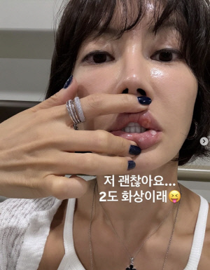 양미라, 입술에 2도 화상 입었다…