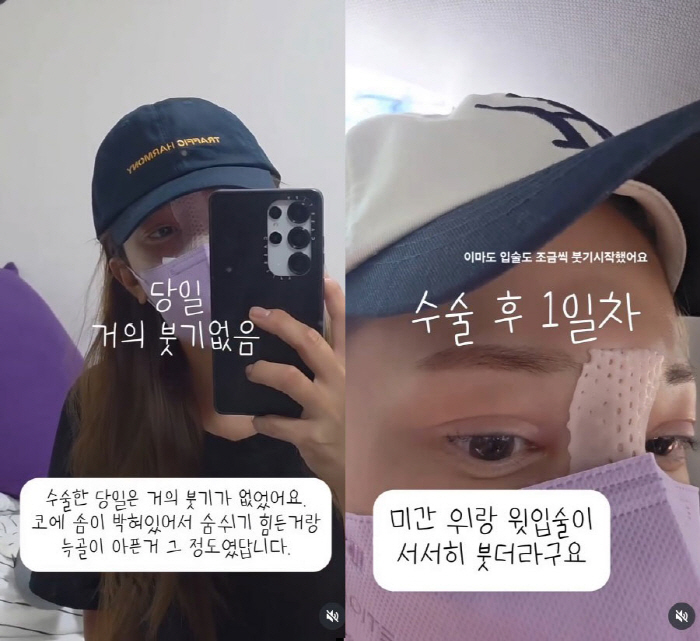 '이용규♥' 유하나, 20년 만에 코 재수술 '리얼 후기'…"코봉이지만 …