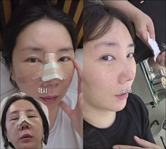 허안나, 코 재성형 대성공…놀라운 비포&애프터 "귀여움 사라진 거 같아"