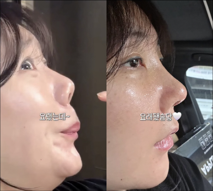 허안나, 코 재성형 대성공…놀라운 비포&애프터 "귀여움 사라진 거 같아"