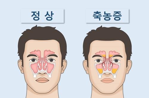 [건강포커스] "만성 부비동염 치료에 항생제보다 부비강 수술이 효과적"