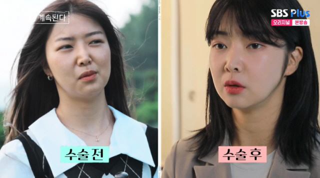 '양악수술' 10기 영자, 미스터 황과 결별 후 눈·코 성형 "숨길 필요…