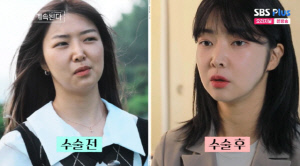 '양악수술' 10기 영자, 미스터 황과 결별 후 눈·코 성형 