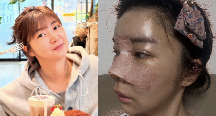 '양악수술' 10기 영자, 미스터 황과 결별 후 눈·코 성형 "숨길 필요…