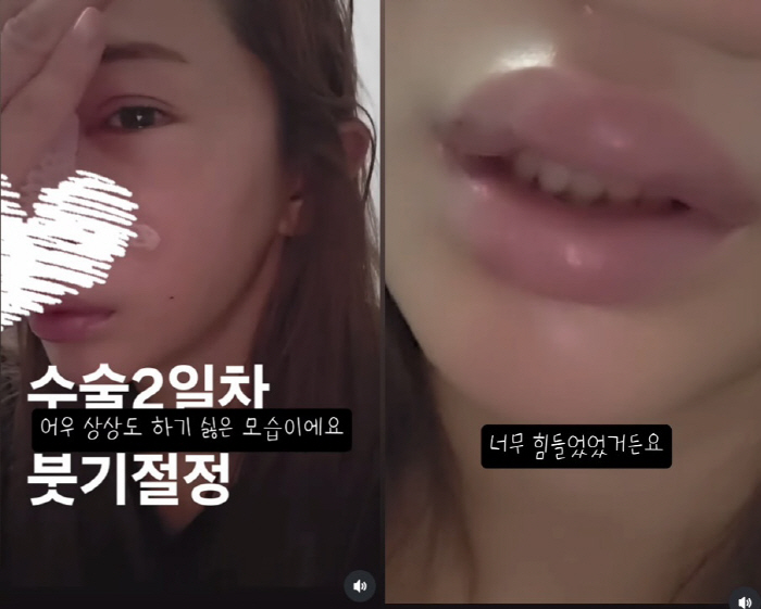'이용규♥' 유하나, 20년만 코 재수술..입술까지 퉁퉁 붓고 '눈물'