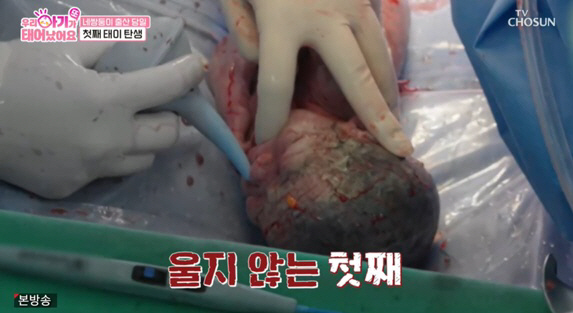 네쌍둥이 출산, 의료진 20명 투입됐지만..4명 다 울음 없이 중환자실行…