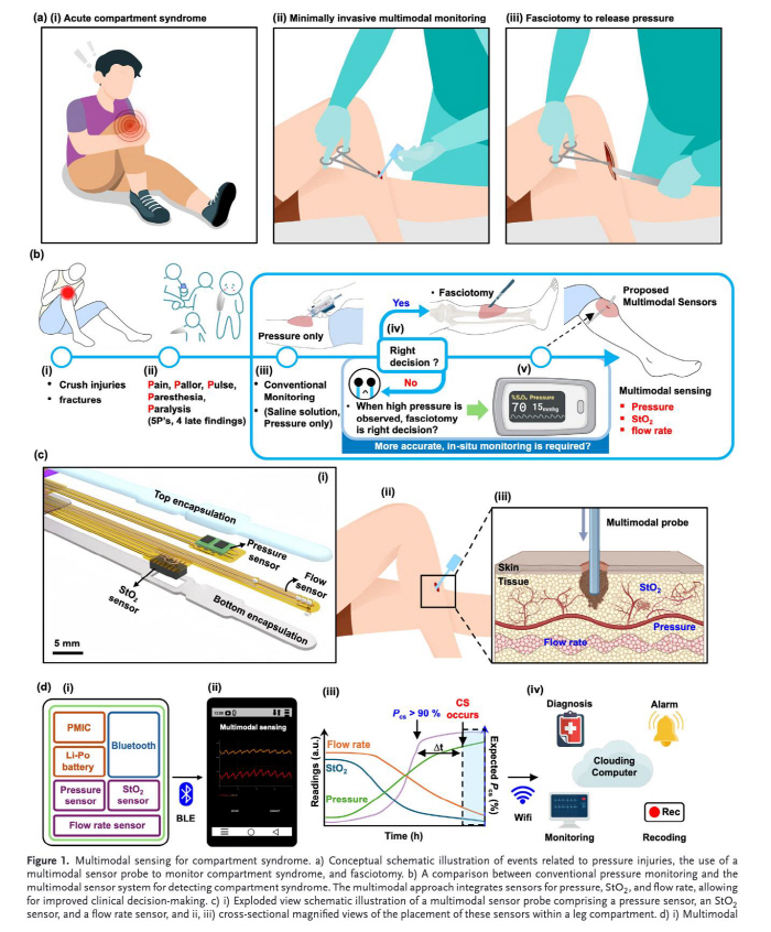 응급질환 '급성 구획 증후군' 조기진단 초소형 멀티모달 센서 세계 최초 개발