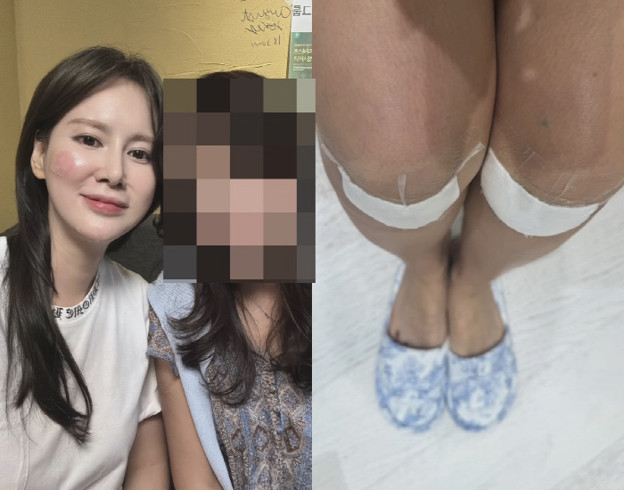 '안정환♥' 이혜원, 추락 사고 후 여전한 붓기 근황...예쁘단 댓글엔 …