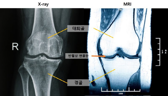 무릎 관절염 조기 진단, 새로운 MRI 지표 확인