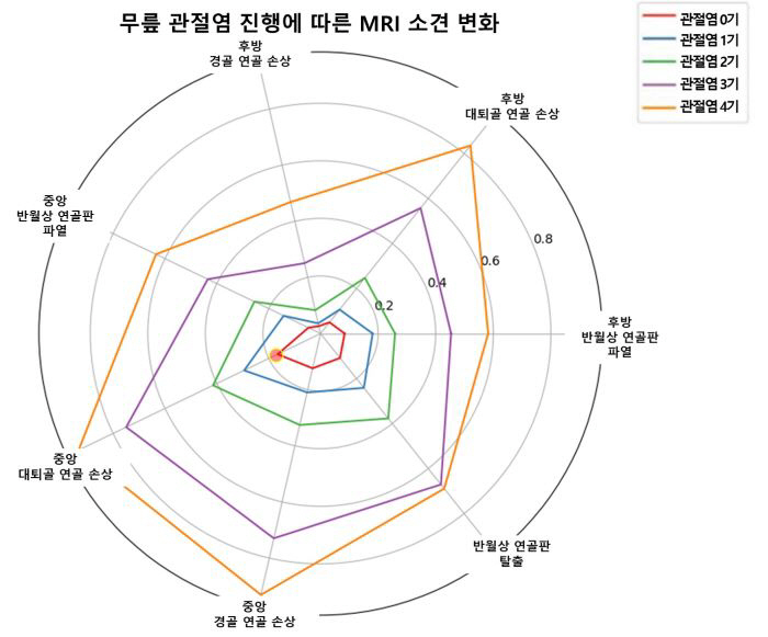 무릎 관절염 조기 진단, 새로운 MRI 지표 확인