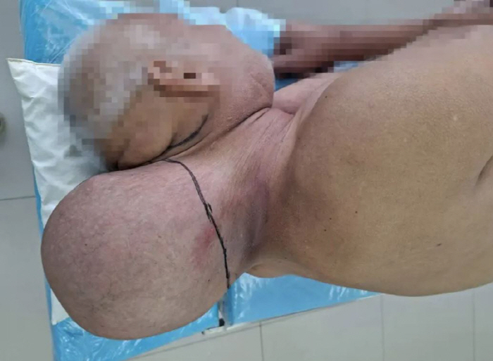 축구공 크기 '혹', 16년간 목에 달고 살던 남성…어떤 질환이길래?