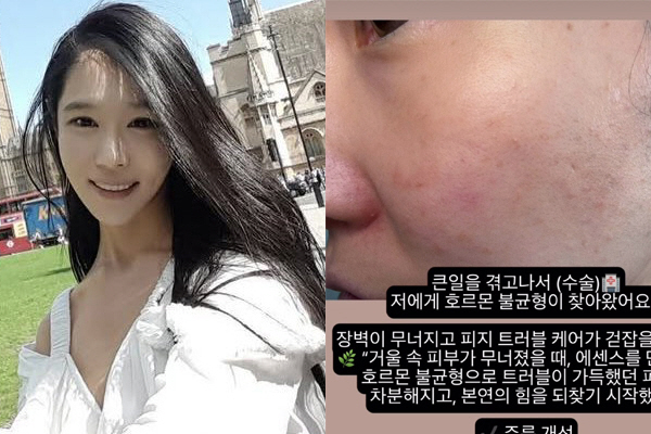 ‘나는 솔로’ 16기 옥순, 유산 후유증 “피부·호르몬 모두 무너져”