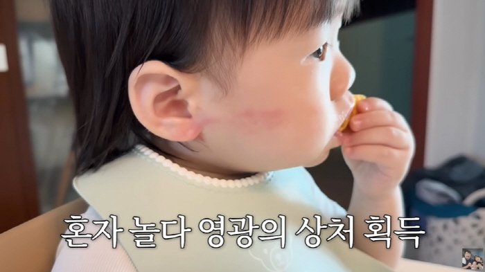 이은형♥강재준, 13개월子 빨갛게 부은 볼 상처에 속상 "혼자 놀다 상처…