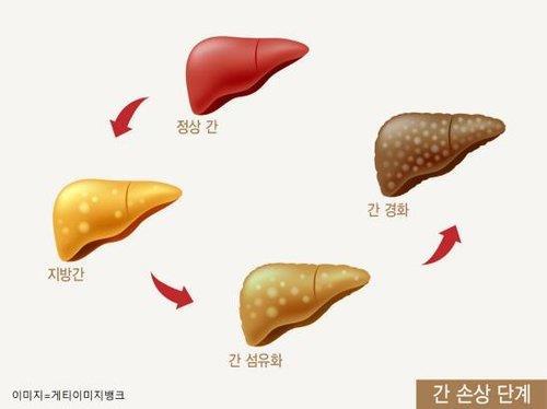 [건강포커스] "간단한 혈액검사로 10년 내 간질환 위험 88% 정확도로 예측"