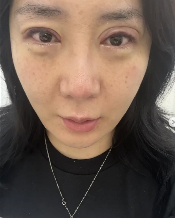 허안나, 코 재수술 이어 눈 시술 고백 "20년만에 속 시원"