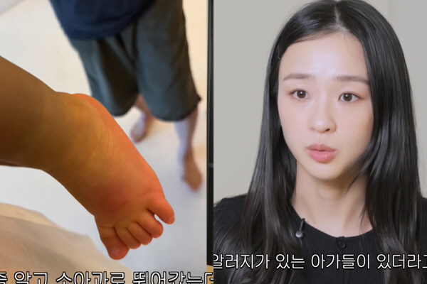손연재, “얼굴 20방 물려 염증과 고름이”..子 모기 알러지에 ‘가슴 …