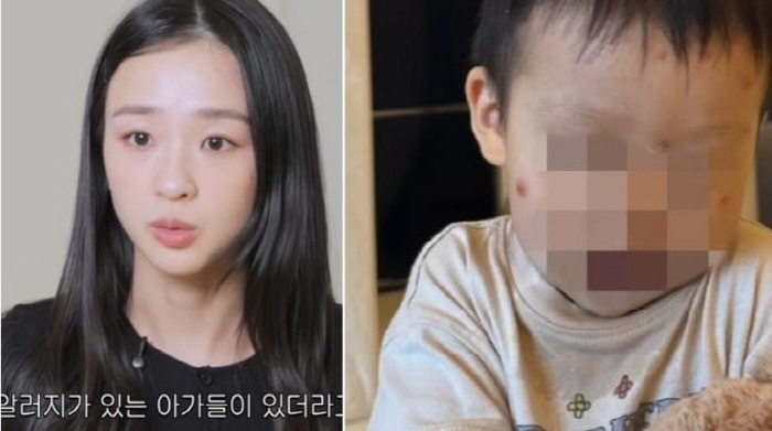 손연재, 子 '스키터 증후군' 고백…"심하게 붓고 고름까지"