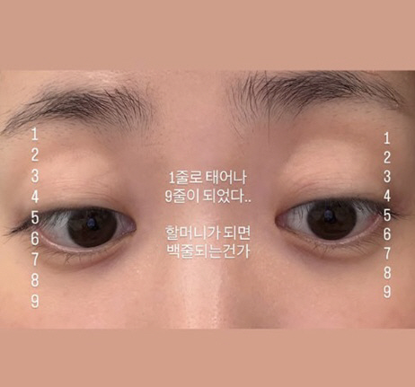 '박수홍♥' 김다예, 쌍꺼풀 주름 고민 고백 "1줄이 9줄로, 할머니 되…