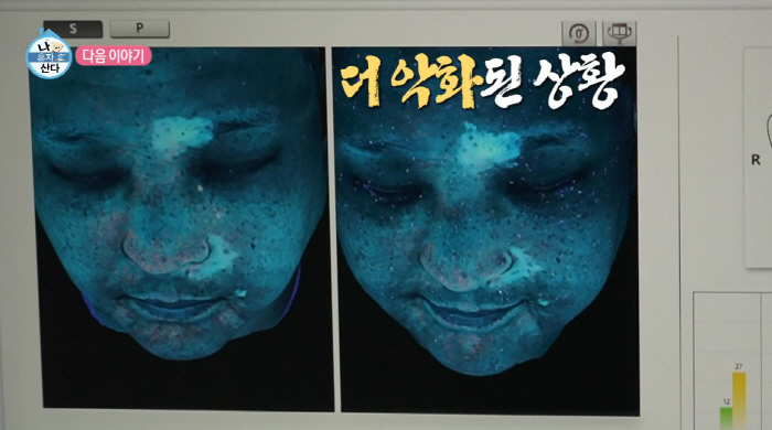 구성환, 백반증 걱정하더니 안타까운 근황..."눈·코·입 번진 흰색 반점…