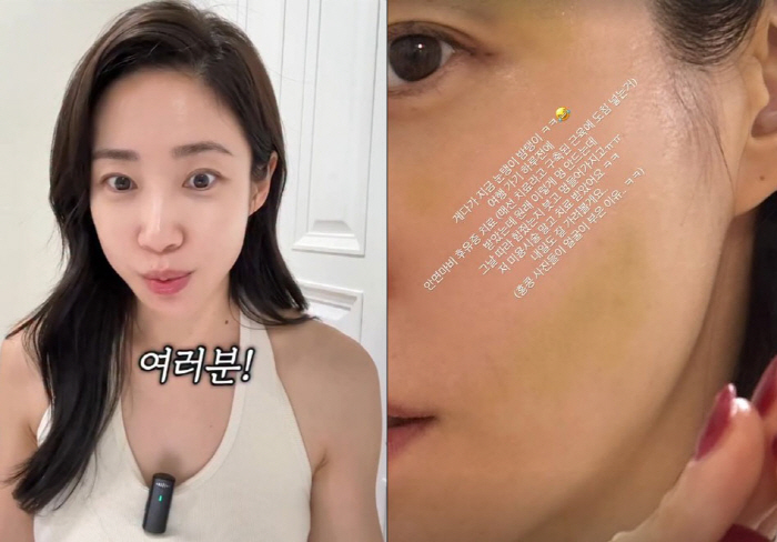 최희, 안면마비 후유증 치료 중 '악재'…"얼굴 피멍에 붓기까지"