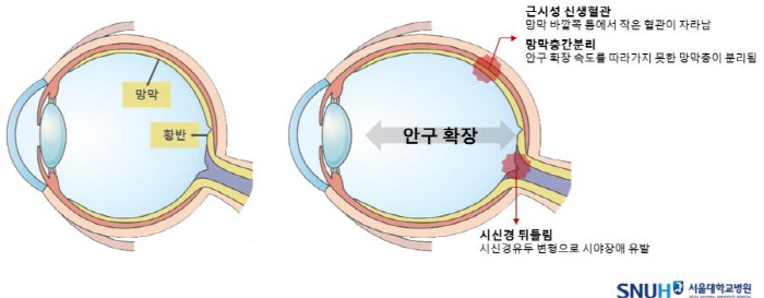 "갑자기 앞이 깜깜해"…고도근시, 망막 건강의 위험 신호