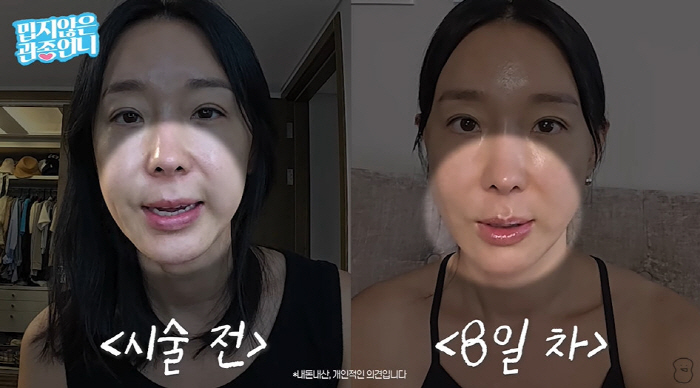 '46세' 이지혜, 실리프팅+입술 문신 고백 "노화 뚜렷해져서 시술 결정…